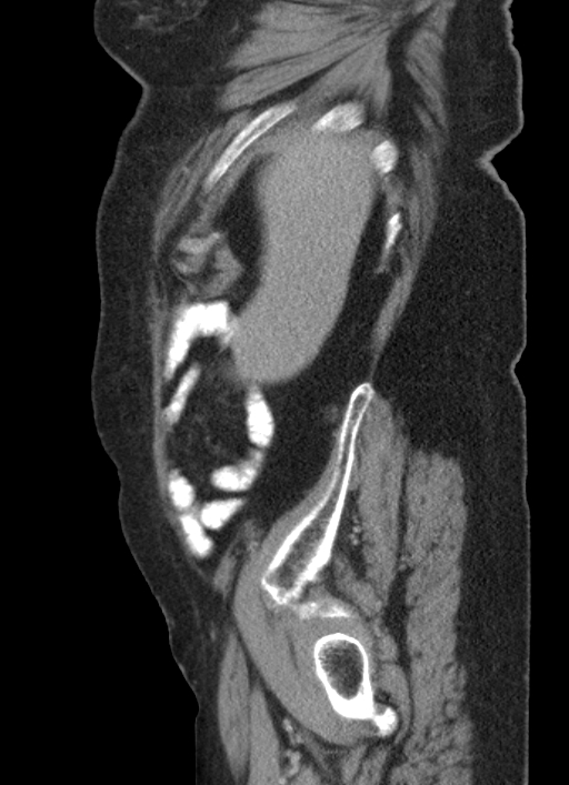 Cecal adenocarcinoma - surgical scar recurrence (Radiopaedia 79988-93264 D 55).jpg