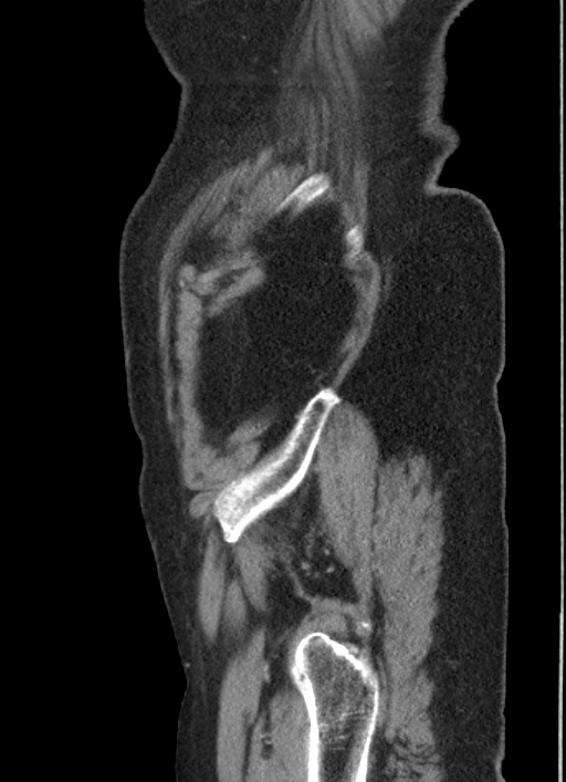 Cecal adenocarcinoma - surgical scar recurrence (Radiopaedia 79988-93264 D 8).jpg