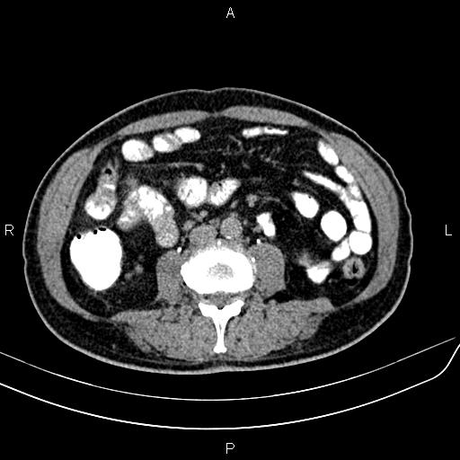 File:Cecal cancer with appendiceal mucocele (Radiopaedia 91080-108651 Axial C+ delayed 38).jpg
