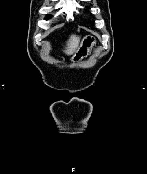 Cecal cancer with appendiceal mucocele (Radiopaedia 91080-108651 D 3).jpg