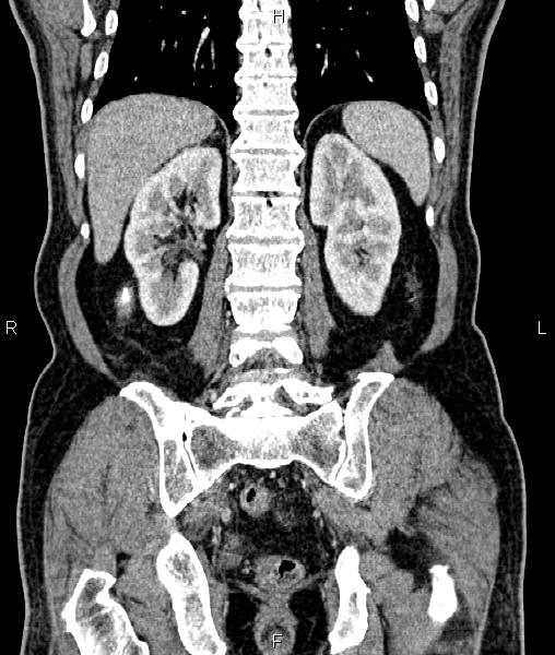 Cecal cancer with appendiceal mucocele (Radiopaedia 91080-108651 D 54).jpg