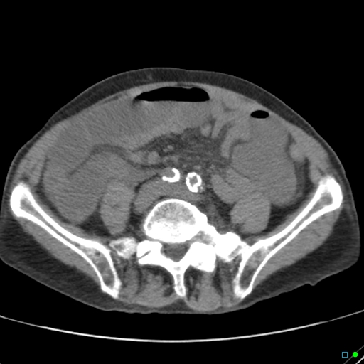 Cecal volvulus - atypical (Radiopaedia 21637-21588 non-contrast 47).jpg