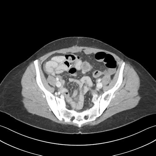 Cecum hernia through the foramen of Winslow (Radiopaedia 46634-51112 A 56).png