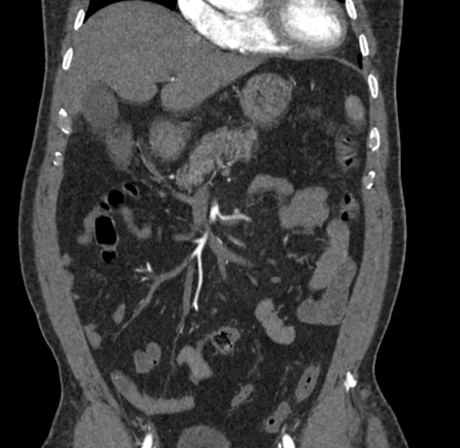 Celiac artery dissection (Radiopaedia 52194-58080 C 12).jpg