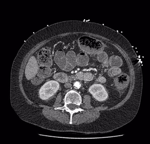 File:Celiac artery severe stenosis and dissection (Radiopaedia 44128-47842 B 46).jpg