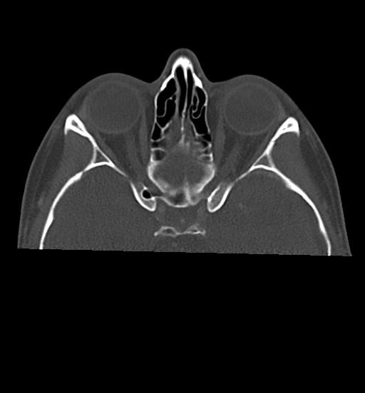 Cemento-ossifying fibroma (Radiopaedia 46243-50643 Axial bone window 17).png