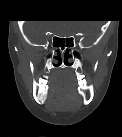 Cemento-ossifying fibroma (Radiopaedia 46243-50643 Coronal bone window 27).png