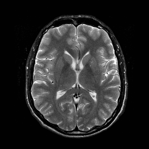File:Central-variant posterior reversible encephalopathy syndrome (PRES) (Radiopaedia 43880-47359 Axial T2 12).jpg