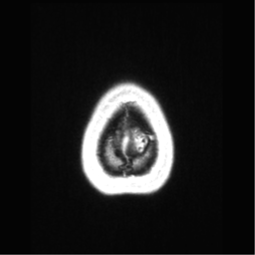 File:Central neurocytoma (Radiopaedia 37664-39557 Axial T1 C+ 76).png