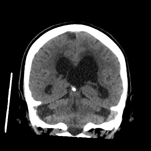Central neurocytoma (Radiopaedia 65317-74346 Coronal non-contrast 38).png