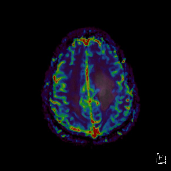 Central neurocytoma (Radiopaedia 84497-99872 Axial Perfusion 69).jpg