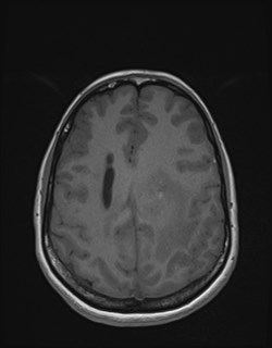 Central neurocytoma (Radiopaedia 84497-99872 Axial T1 139).jpg