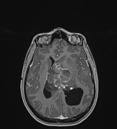Central neurocytoma (Radiopaedia 84497-99872 Axial T1 C+ 88).jpg