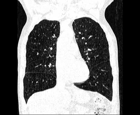 Centrilobular pulmonary emphysema (Radiopaedia 62468-70718 Coronal lung window 28).jpg