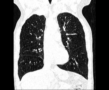 Centrilobular pulmonary emphysema (Radiopaedia 62468-70718 Coronal lung window 30).jpg