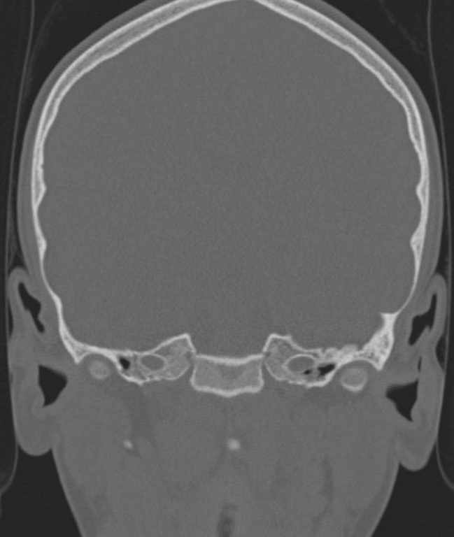 Cerebellar abscess (Radiopaedia 73727-84527 Coronal bone window 82).jpg