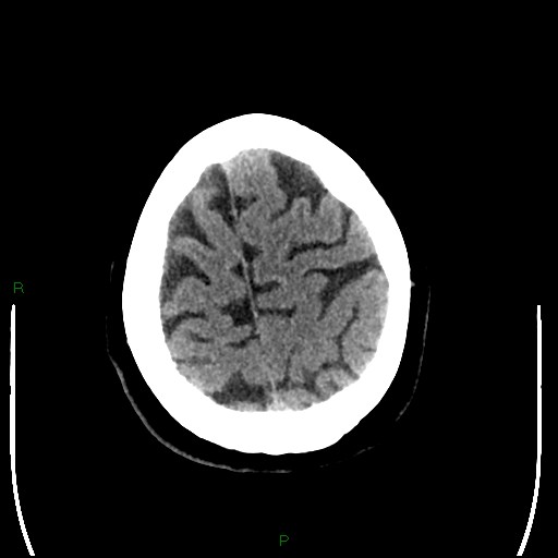 Cerebellar abscess (Radiopaedia 78135-90671 Axial non-contrast 94).jpg