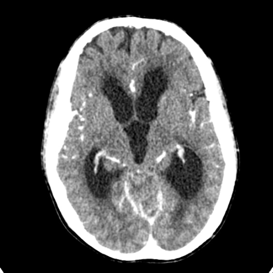 Cerebellar abscess secondary to mastoiditis (Radiopaedia 26284-26412 Axial C+ delayed 70).jpg