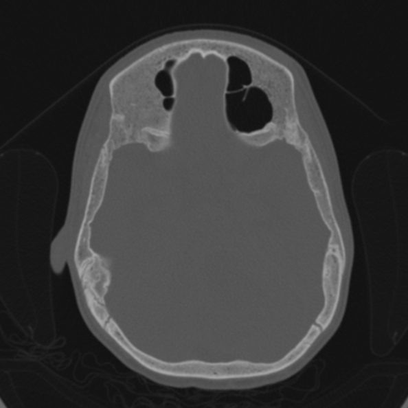 Cerebellar abscess secondary to mastoiditis (Radiopaedia 26284-26413 Axial bone window 83).jpg