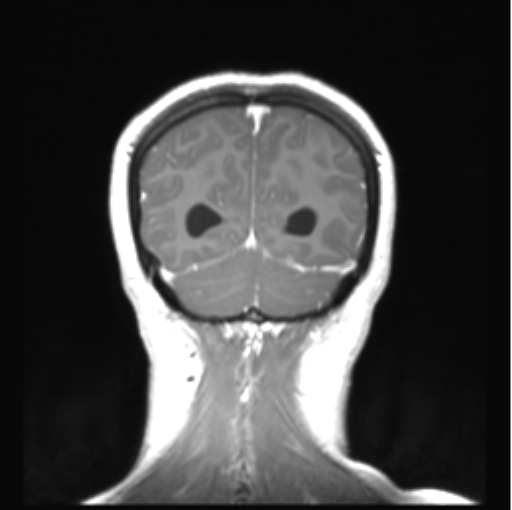File:Cerebellar ependymoma complicated by post-operative subdural hematoma (Radiopaedia 83322-97736 Coronal T1 C+ 48).png