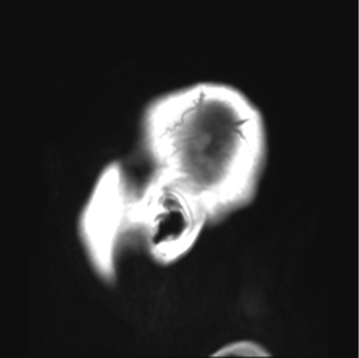 File:Cerebellar ependymoma complicated by post-operative subdural hematoma (Radiopaedia 83322-97736 Sagittal T1 1).png