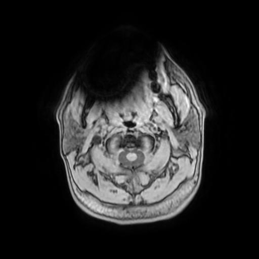 File:Cerebellar hemangioblastoma (Radiopaedia 88055-104622 Axial T1 1).jpg
