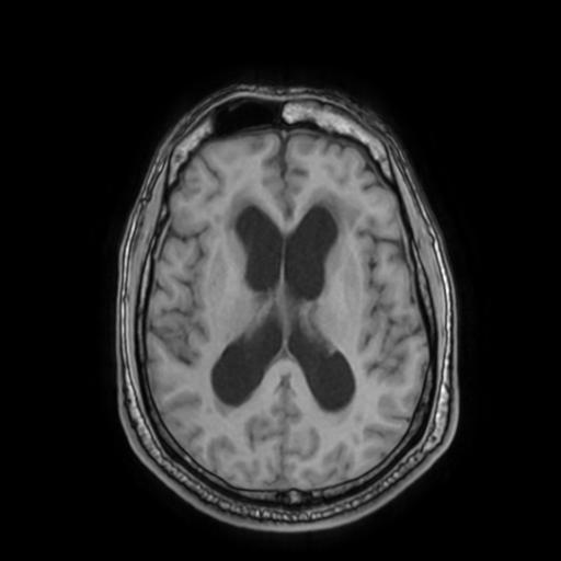 File:Cerebellar hemangioblastoma (Radiopaedia 88055-104622 Axial T1 21).jpg
