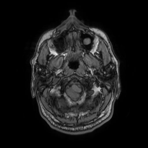 File:Cerebellar hemangioblastoma (Radiopaedia 88055-104622 Axial T1 6).jpg