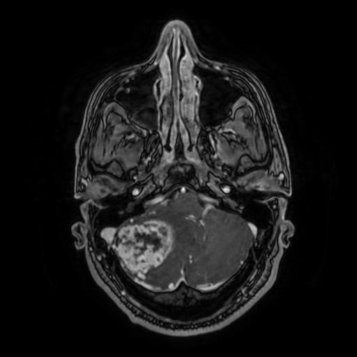 Cerebellar hemangioblastoma (Radiopaedia 88055-104622 Axial T1 C+ 49).jpg