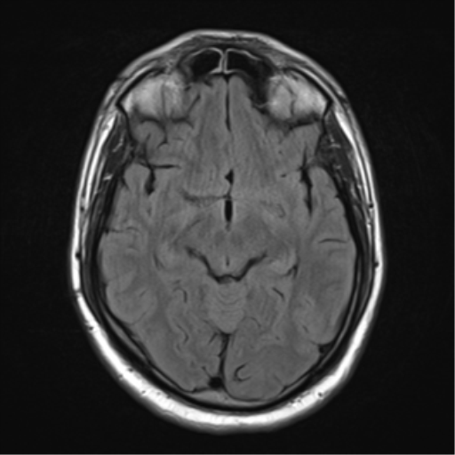 File:Cerebellar hemangioblastomas and pituitary adenoma (Radiopaedia 85490-101176 Axial FLAIR 13).png