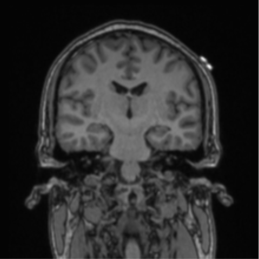 Cerebellar hemangioblastomas and pituitary adenoma (Radiopaedia 85490-101176 Coronal T1 46).png