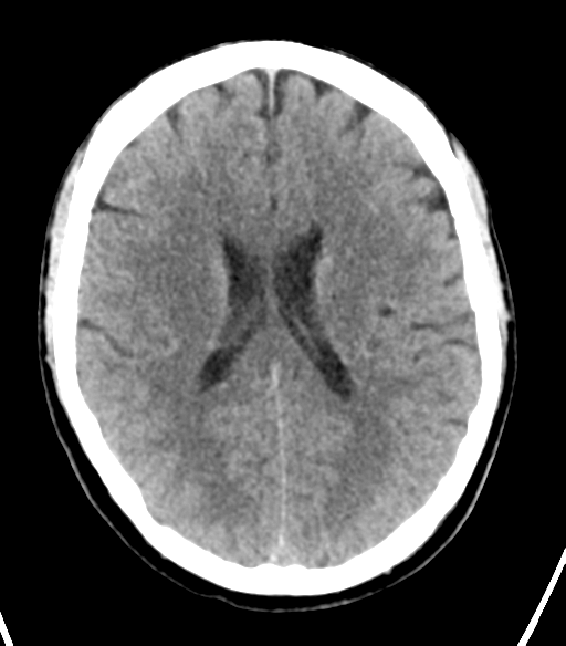 File:Cerebellar hemorrhage (Radiopaedia 37000-38669 Axial non-contrast 24).png