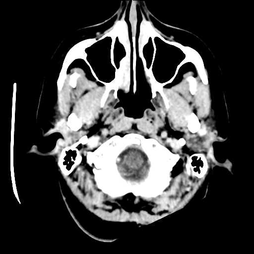 Cerebellar metastasis (cystic appearance) (Radiopaedia 41395-44258 B 5).png