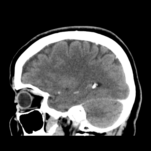Cerebellar metastasis (cystic appearance) (Radiopaedia 41395-44258 F 18).png