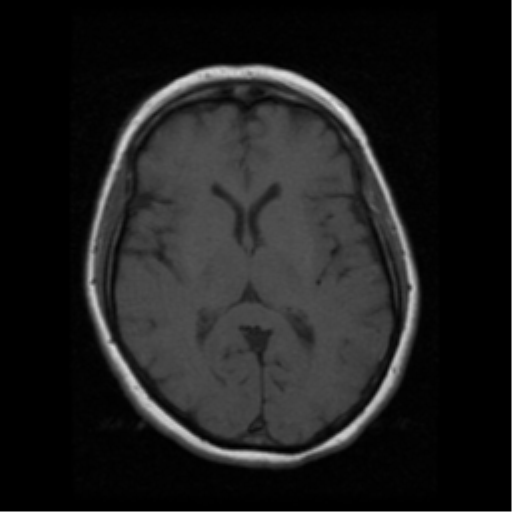 File:Cerebellar metastasis (cystic appearance) (Radiopaedia 41395-44262 Axial T1 12).png