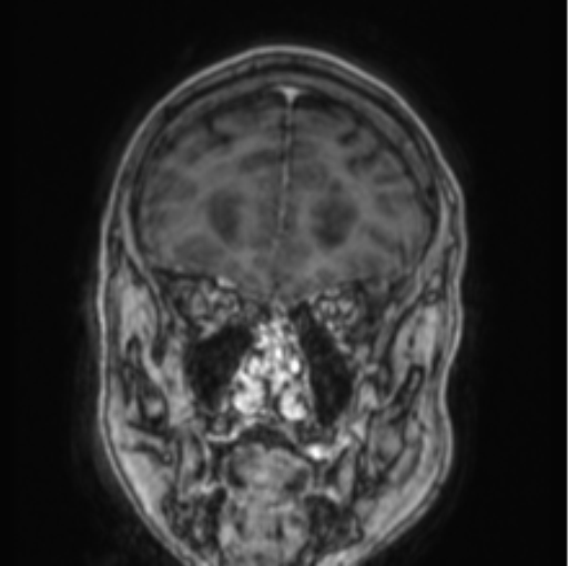 Cerebellar metastasis from lung adenocarcinoma (Radiopaedia 86690-102829 Coronal T1 C+ 76).png