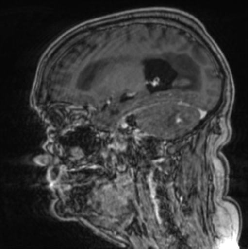 Cerebellar metastasis from lung adenocarcinoma (Radiopaedia 86690-102829 Sagittal T1 C+ 54).png
