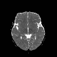 File:Cerebellar stroke (Radiopaedia 32202-33150 Axial ADC 12).png
