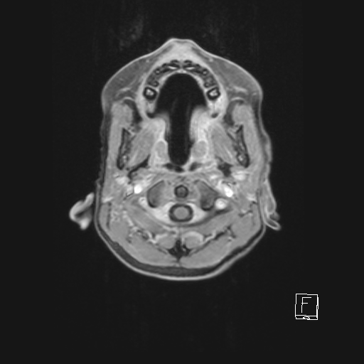 Cerebellar stroke (Radiopaedia 32202-33150 Axial T1 C+ 11).png