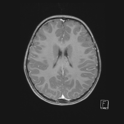 Cerebellar stroke (Radiopaedia 32202-33150 Axial T1 C+ 46).png