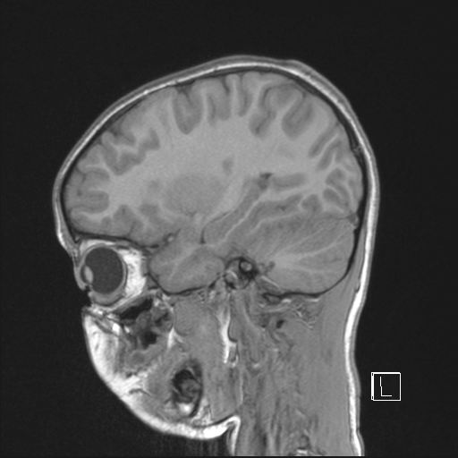 Cerebellar stroke (Radiopaedia 32202-33150 Sagittal T1 C+ 16).png