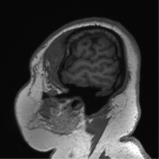 Cerebellopontine angle meningioma (Radiopaedia 48434-53348 Sagittal T1 15).png