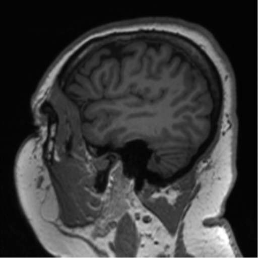 Cerebellopontine angle meningioma (Radiopaedia 48434-53348 Sagittal T1 21).png