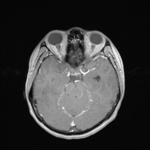Cerebral abscess (Radiopaedia 24212-24478 Axial T1 C+ 25).jpg