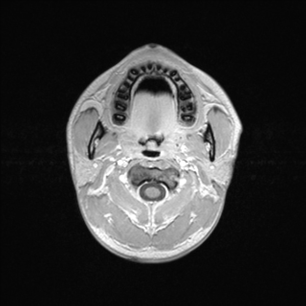 Cerebral abscess (Radiopaedia 24212-24478 Axial T1 C+ 3).jpg
