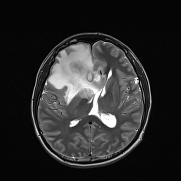 File:Cerebral abscess (Radiopaedia 24212-24478 Axial T2 35).jpg