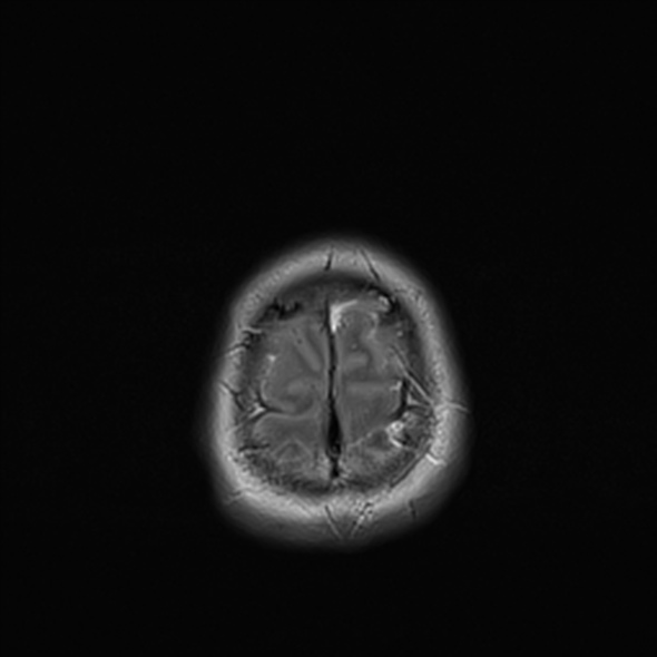 Cerebral abscess (Radiopaedia 24212-24478 Axial T2 54).jpg