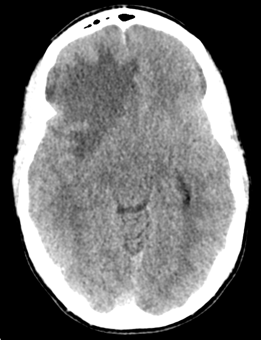 Cerebral abscess (Radiopaedia 60342-68008 Axial non-contrast 23).png