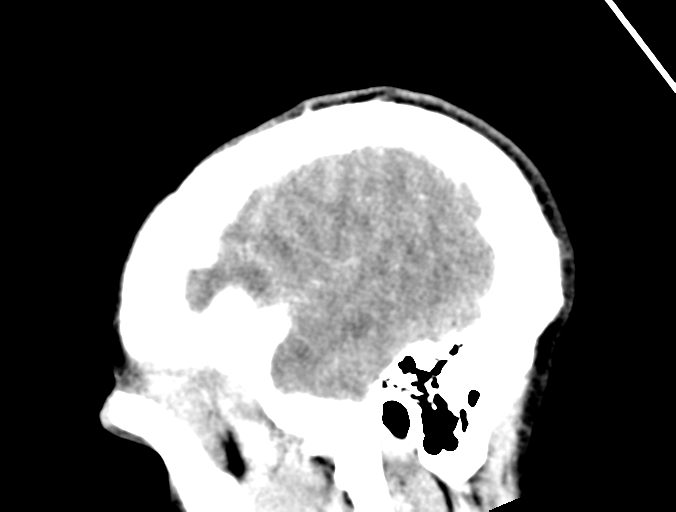 File:Cerebral abscess (Radiopaedia 60342-68008 Sagittal C+ delayed 44).png