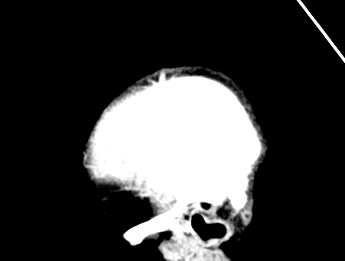 Cerebral abscess (Radiopaedia 60342-68008 Sagittal C+ delayed 47).png